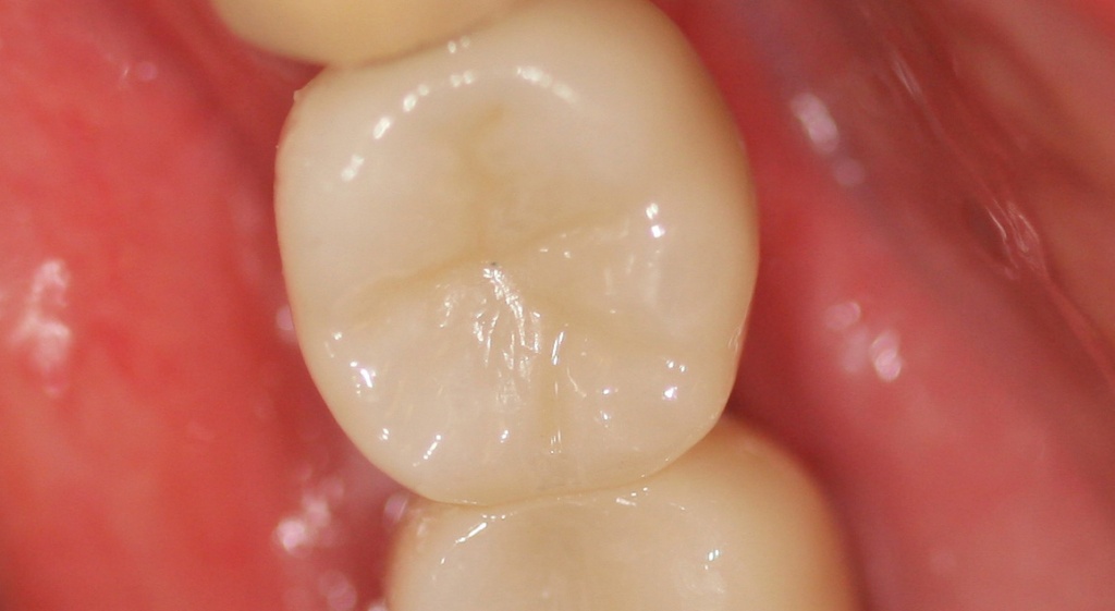 Восстановление анатомии зуба